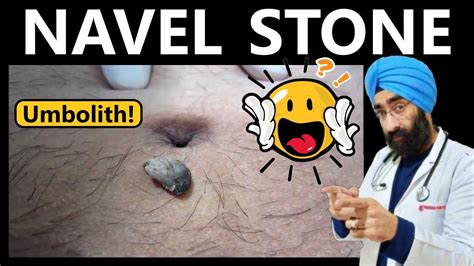 navel stone symptoms|Naval Stones: Causes and Treatment